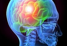 Top 10 Facts About Rehabilitation in Traumatic Brain Injury In 2023